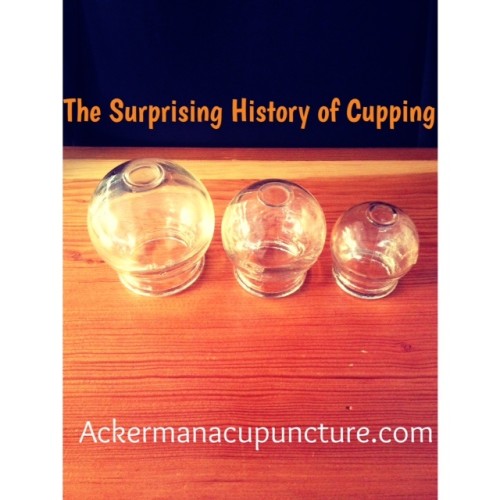 The Surprising History of Cupping (Blaine Acupuncture Back Pain Therapy Clinic)