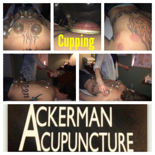 Cupping 101 (Anoka Acupuncture Pain Therapy Clinic)