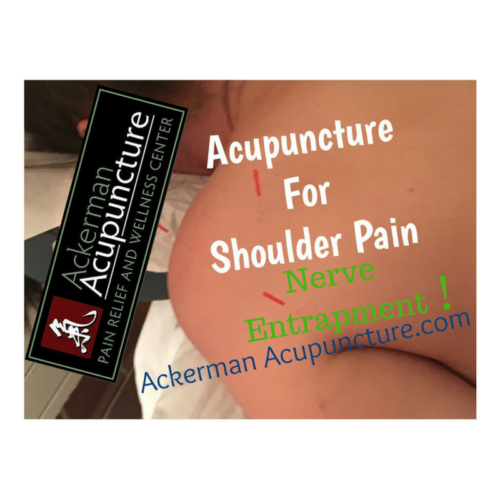 Treating Shoulder Pain Nerve Impingement At Ackerman Acupuncture (in Blaine)