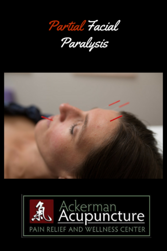 Acupuncture Treats Partial Facial Paralysis (Blaine, MN)